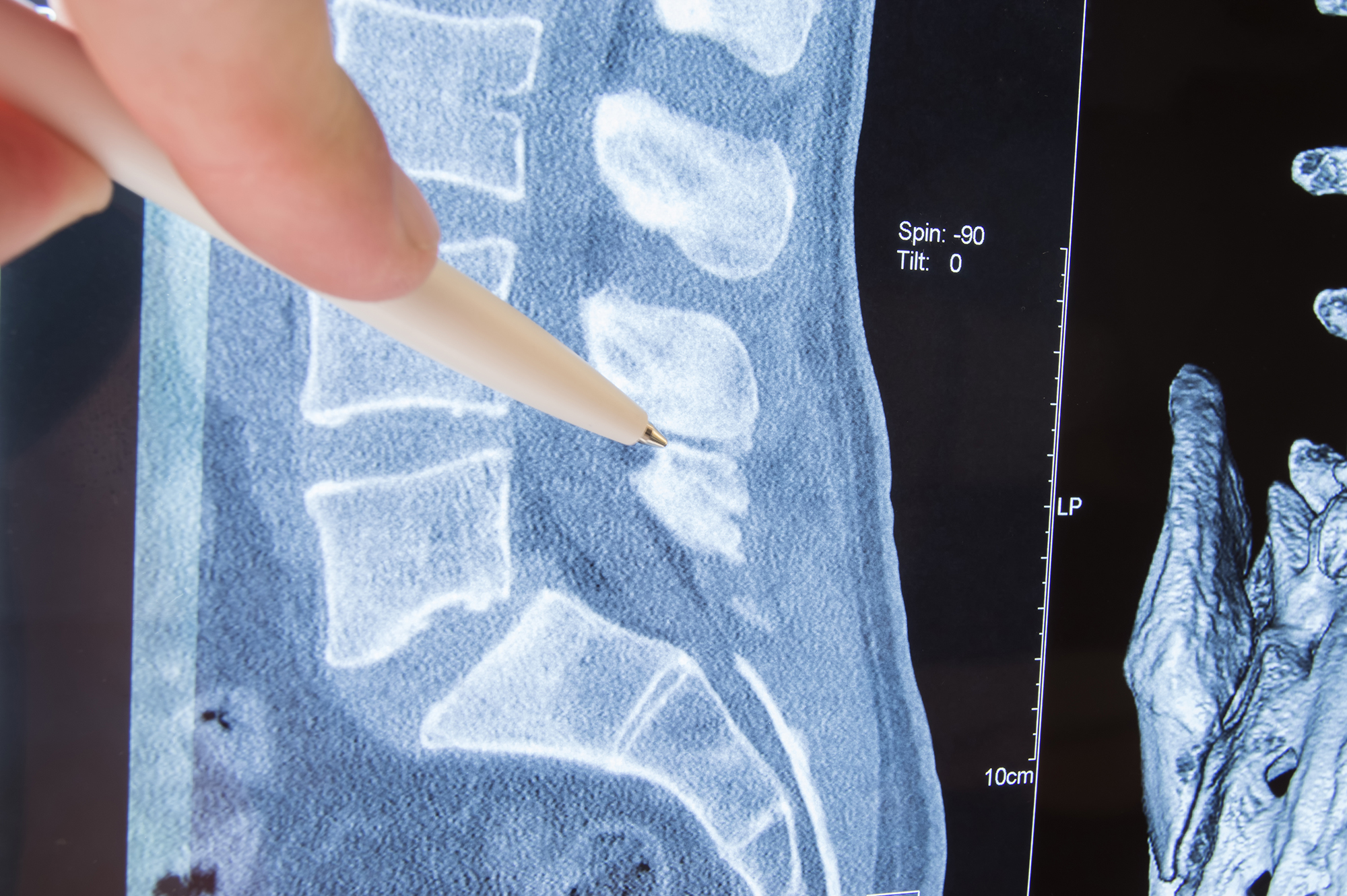 radiologie hernie discale